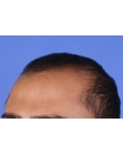 Before Hair Transplant&nbsp;2 Sessions (Areas)